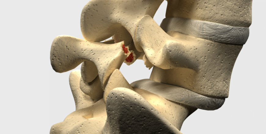 spondylolisthesis