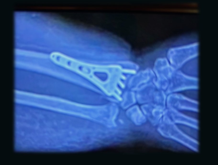 wrist fx